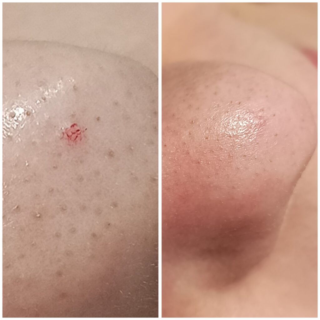 Zamykanie Naczynek  Znamion Rubinowych Bydgoszcz 03